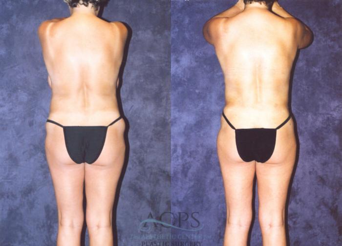Before & After Brazilian Butt Lift (BBL) Case 467 Rear View: View in Houston, TX
