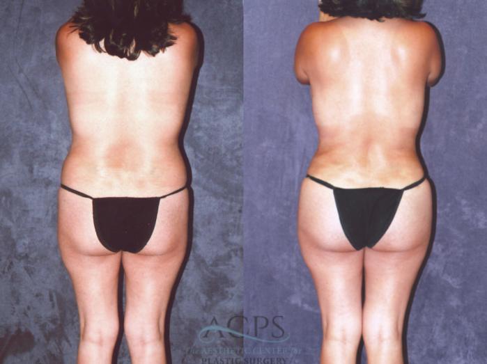 Before & After Brazilian Butt Lift (BBL) Case 468 Rear View: View in Houston, TX