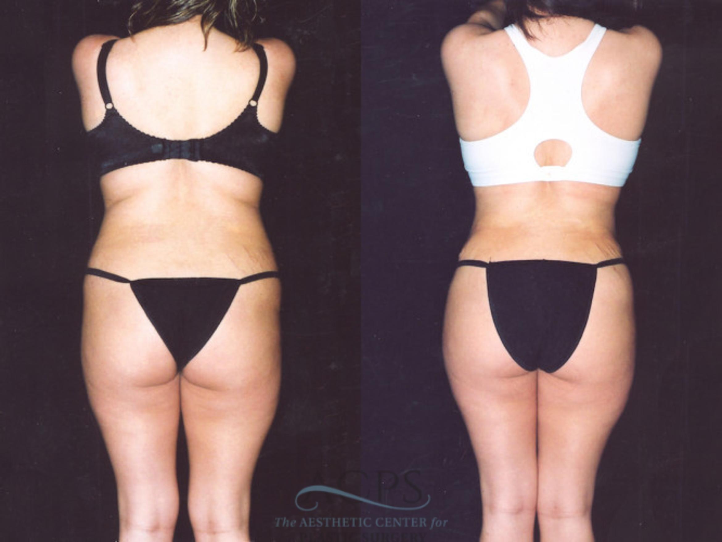 Before & After Brazilian Butt Lift (BBL) Case 469 Rear View: View in Houston, TX