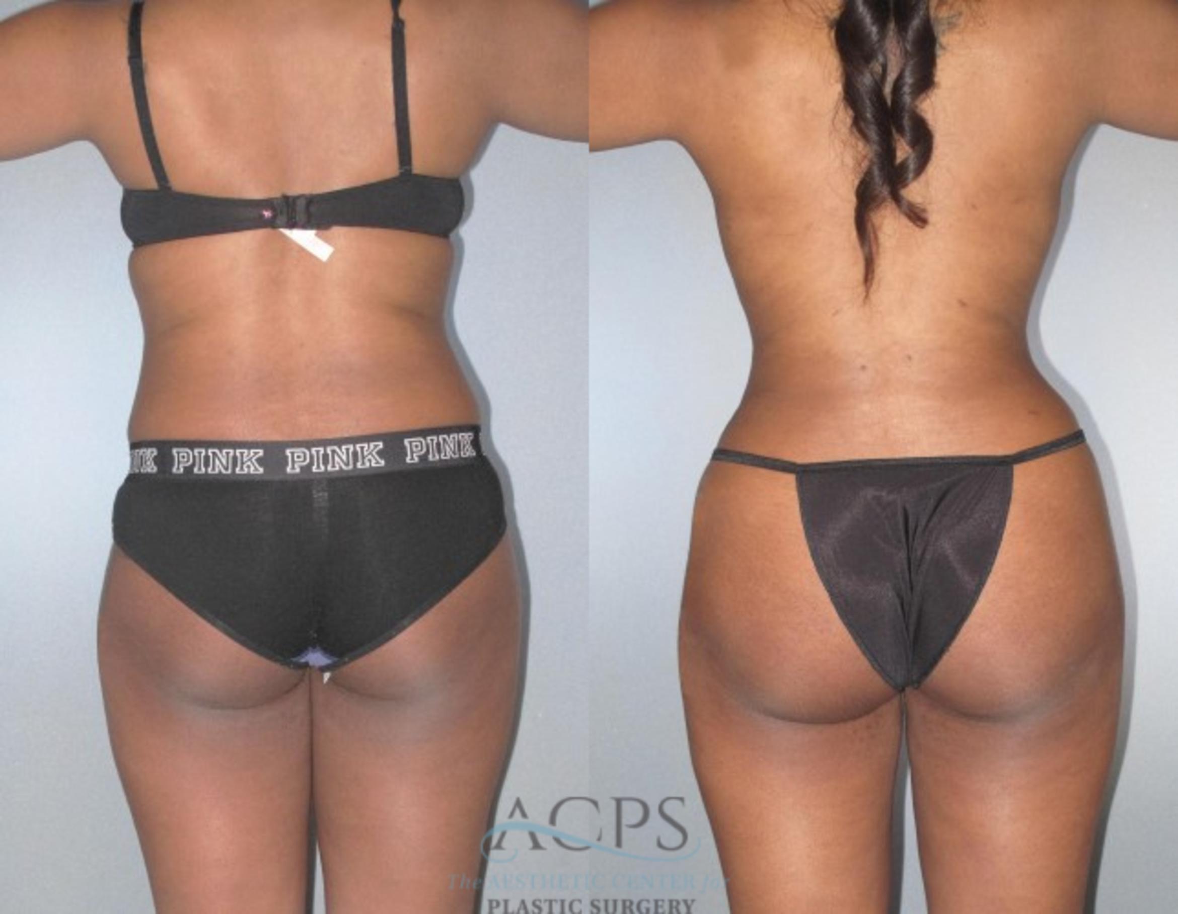 Before & After Brazilian Butt Lift (BBL) Case 470 Rear View: View in Houston, TX