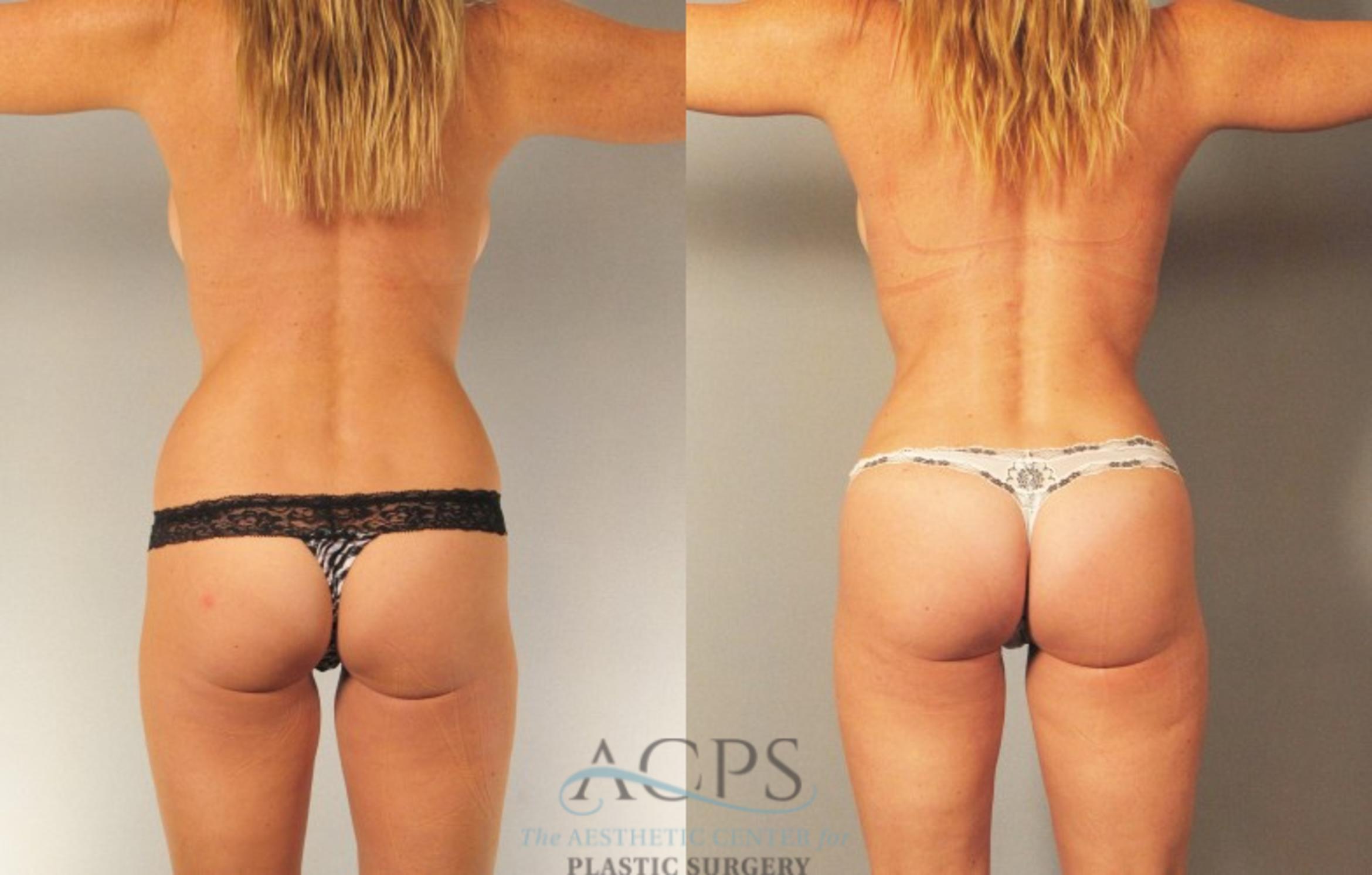 Before & After Brazilian Butt Lift (BBL) Case 471 Rear View: View in Houston, TX