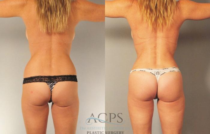 Before & After Brazilian Butt Lift (BBL) Case 471 Rear View: View in Houston, TX
