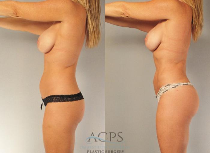 Before & After Brazilian Butt Lift (BBL) Case 471 Side Left View: View in Houston, TX