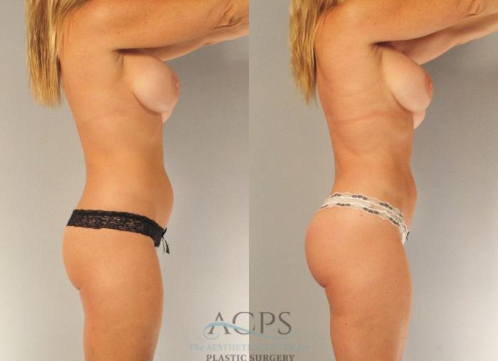 Before & After Brazilian Butt Lift (BBL) Case 471 Side Right View: View in Houston, TX