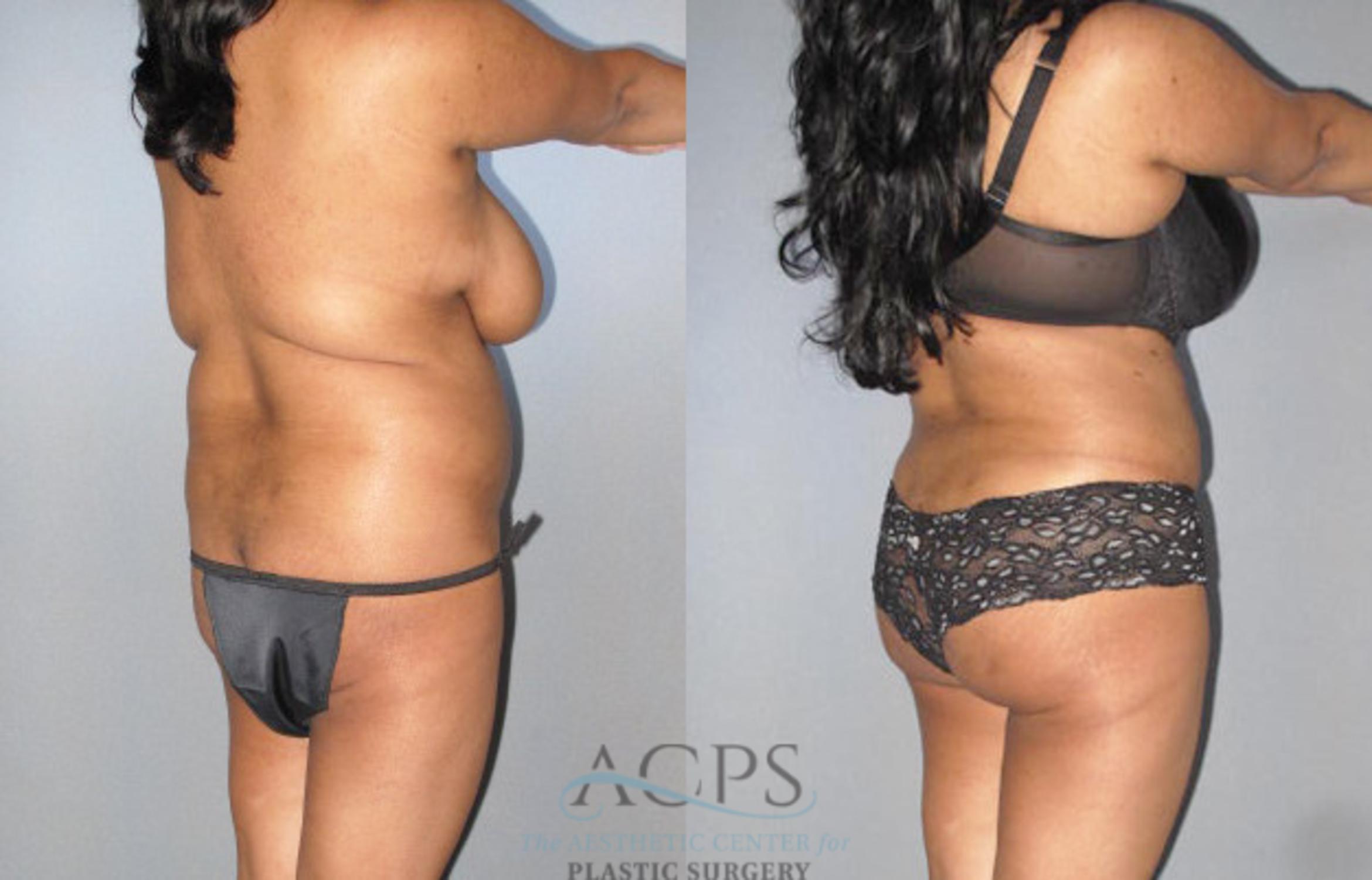 Before & After Brazilian Butt Lift (BBL) Case 472 Oblique View: View in Houston, TX
