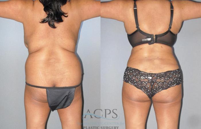 Before & After Brazilian Butt Lift (BBL) Case 472 Rear View: View in Houston, TX
