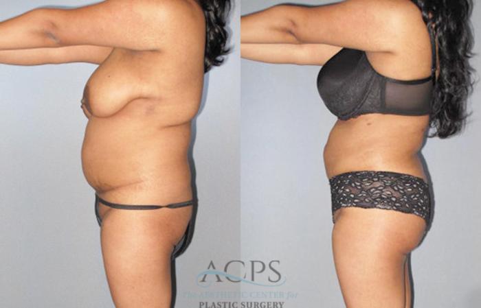 Before & After Brazilian Butt Lift (BBL) Case 472 Side View: View in Houston, TX