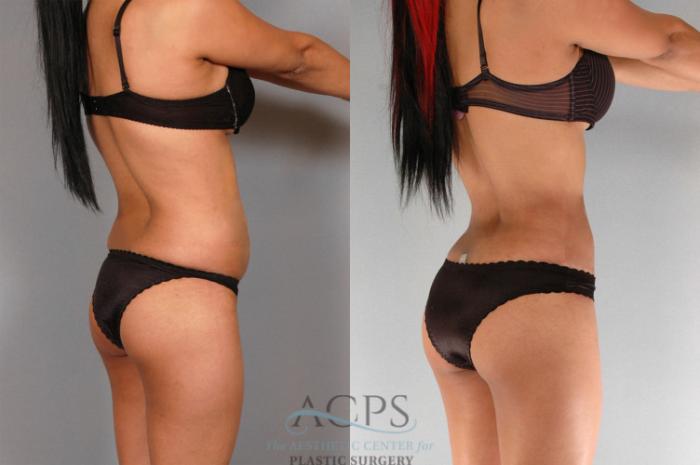 Before & After Brazilian Butt Lift (BBL) Case 473 Oblique View: View in Houston, TX