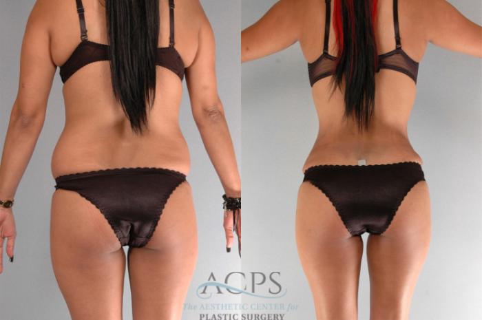 Before & After Brazilian Butt Lift (BBL) Case 473 Rear View: View in Houston, TX