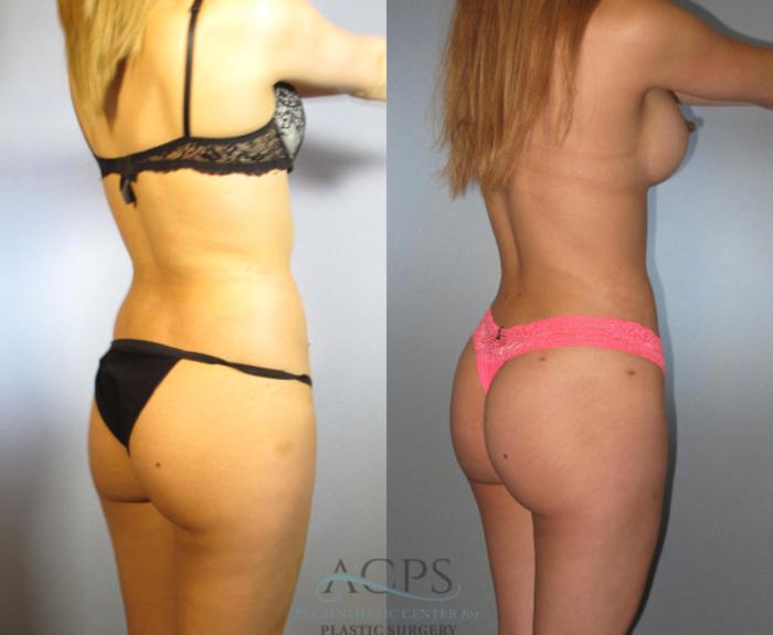 Before & After Brazilian Butt Lift (BBL) Case 474 Oblique View: View in Houston, TX