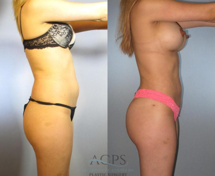 Before & After Brazilian Butt Lift (BBL) Case 474 Side View: View in Houston, TX