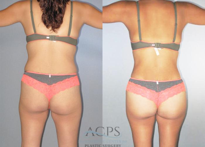 Before & After Brazilian Butt Lift (BBL) Case 475 Rear View: View in Houston, TX