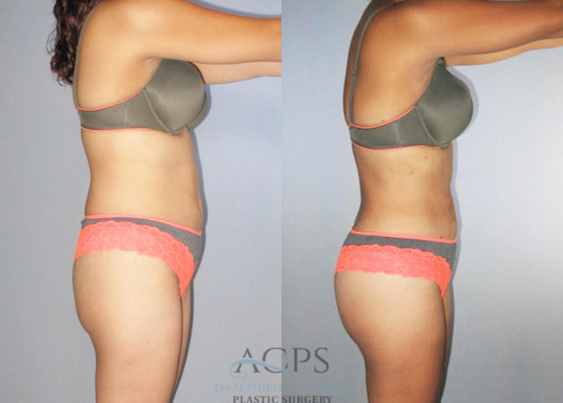 Before & After Brazilian Butt Lift (BBL) Case 475 Side View: View in Houston, TX