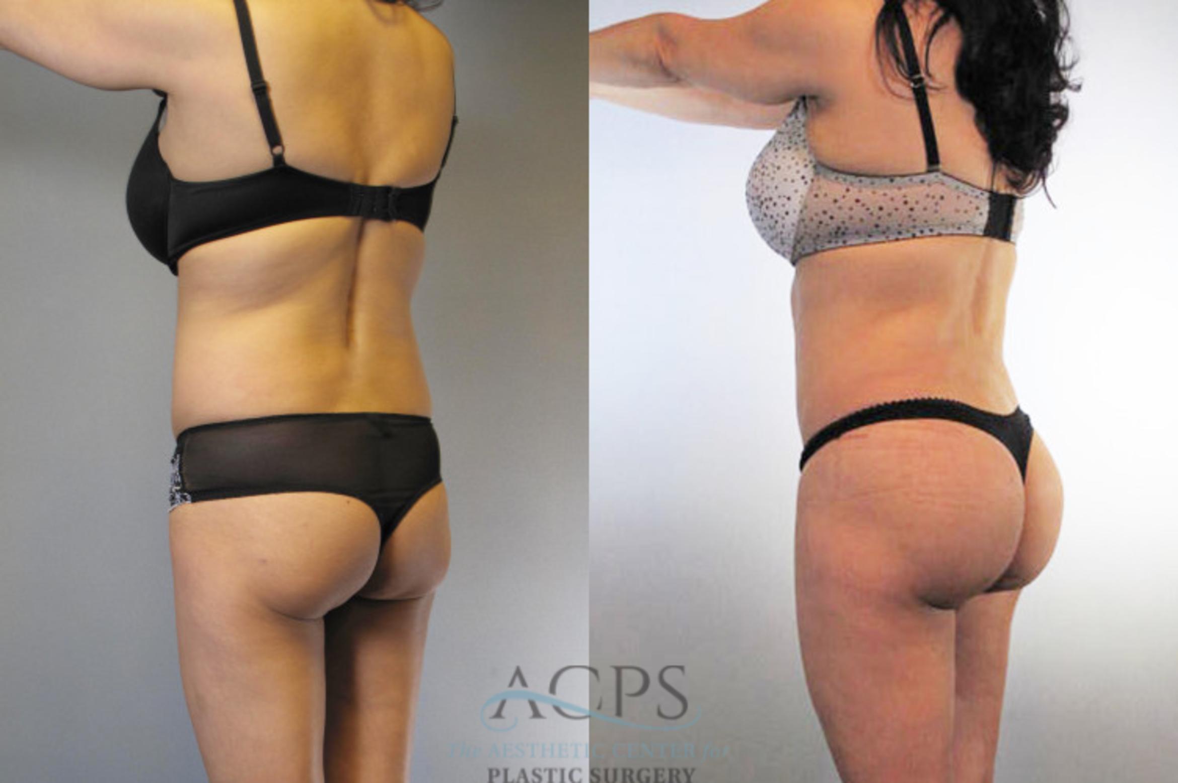 Before & After Brazilian Butt Lift (BBL) Case 476 Oblique Left View: View in Houston, TX
