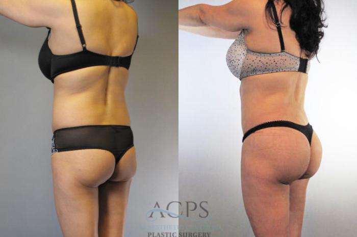 Before & After Brazilian Butt Lift (BBL) Case 476 Oblique Left View: View in Houston, TX