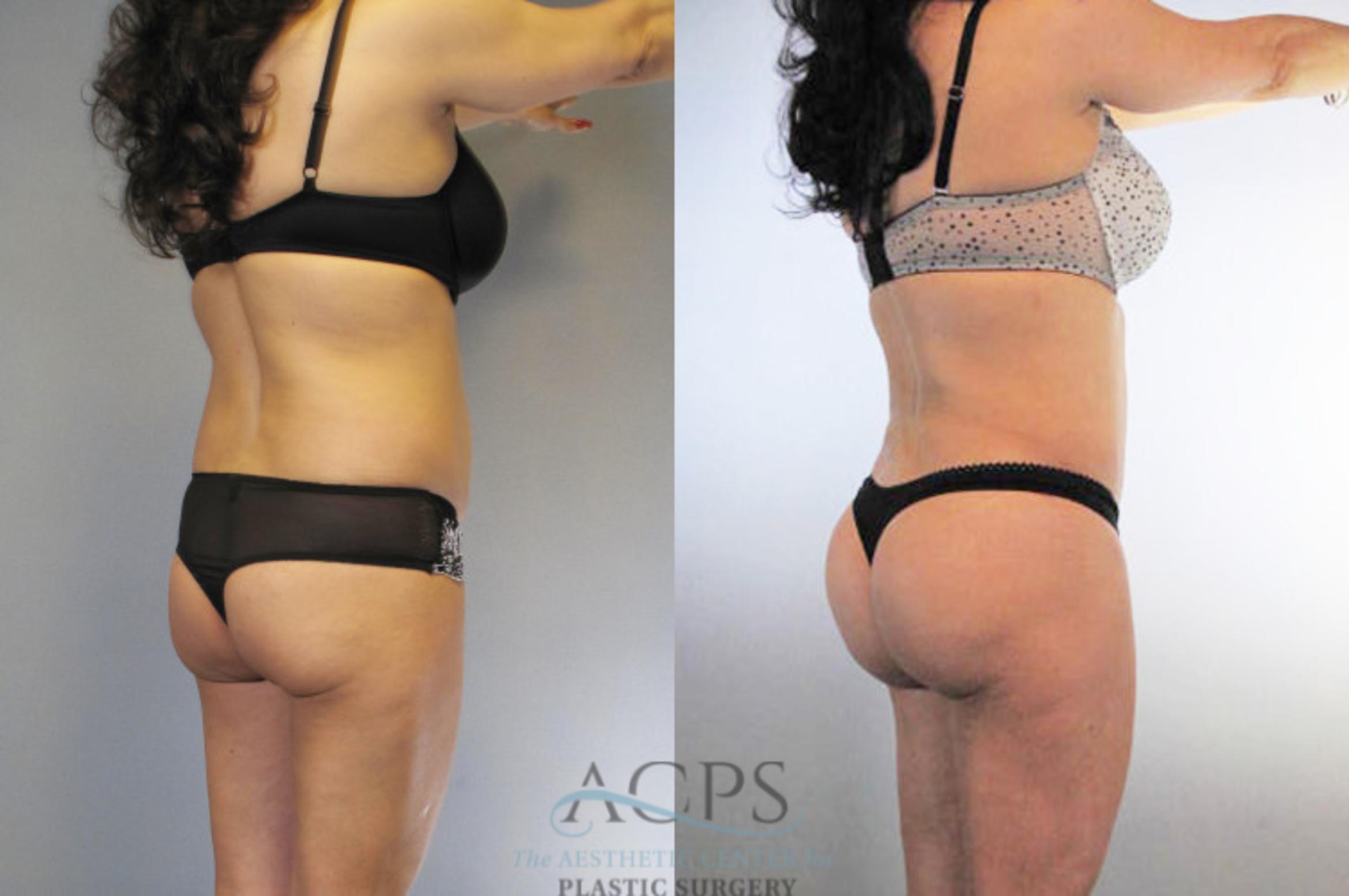 Before & After Brazilian Butt Lift (BBL) Case 476 Oblique Right View: View in Houston, TX