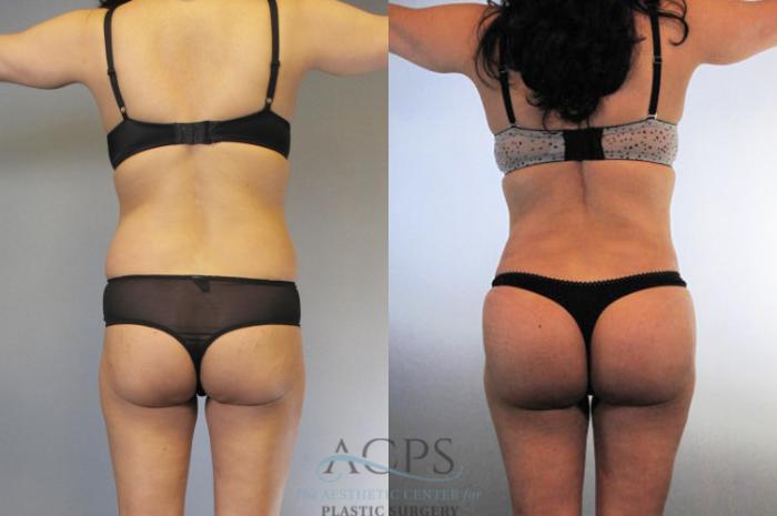 Before & After Brazilian Butt Lift (BBL) Case 476 Rear View: View in Houston, TX