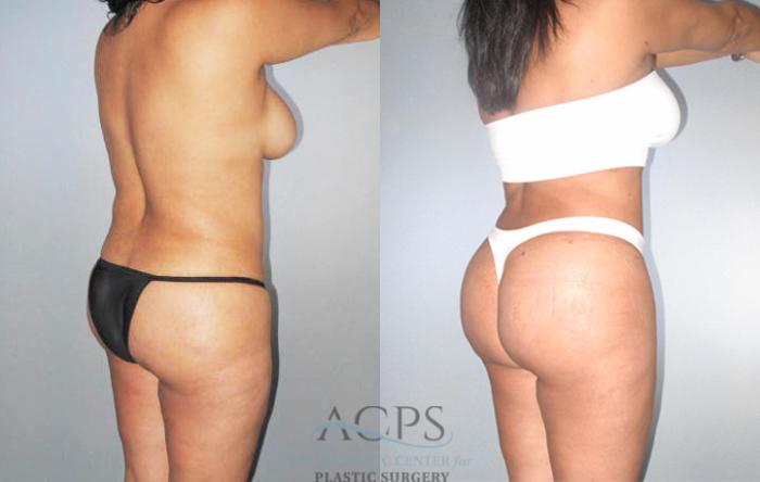 Before & After Brazilian Butt Lift (BBL) Case 477 Oblique View: View in Houston, TX