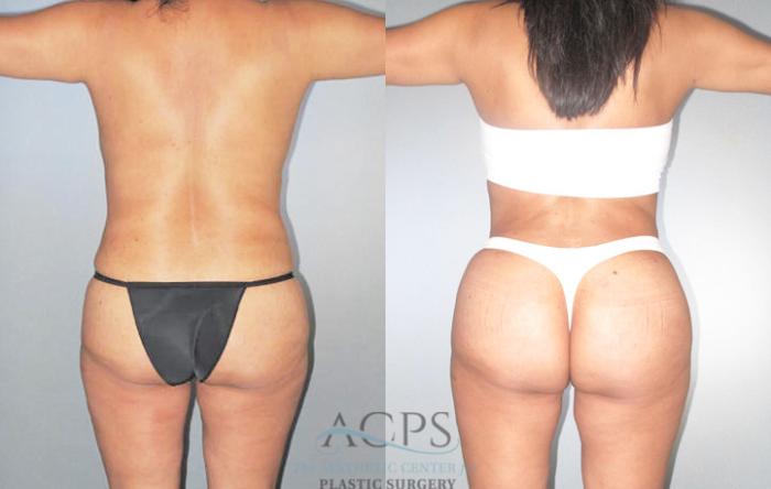 Before & After Brazilian Butt Lift (BBL) Case 477 Rear View: View in Houston, TX