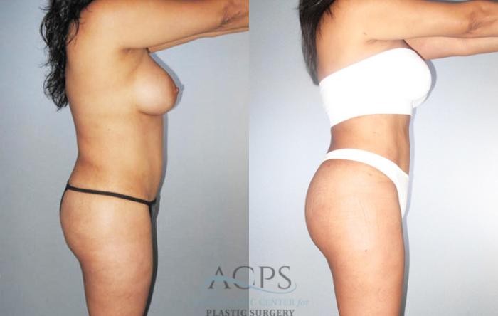Before & After Brazilian Butt Lift (BBL) Case 477 Side View: View in Houston, TX