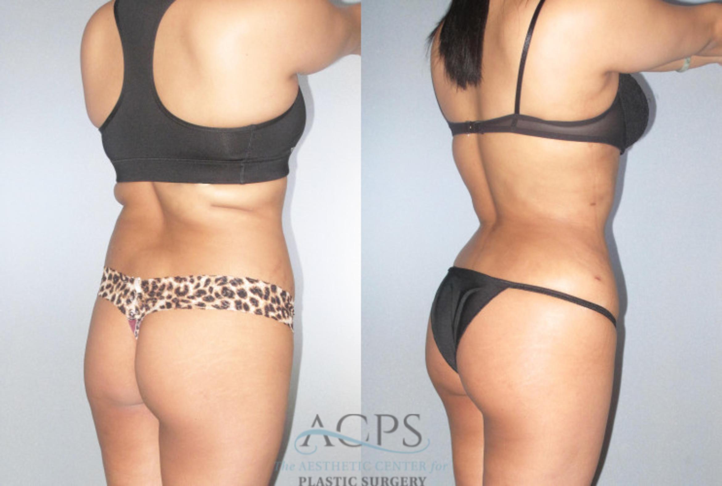 Before & After Brazilian Butt Lift (BBL) Case 478 Oblique View: View in Houston, TX