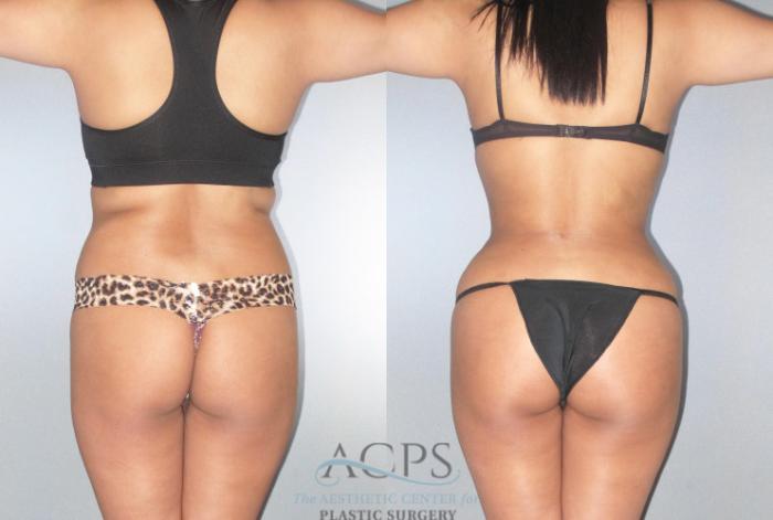 Before & After Brazilian Butt Lift (BBL) Case 478 Rear View: View in Houston, TX