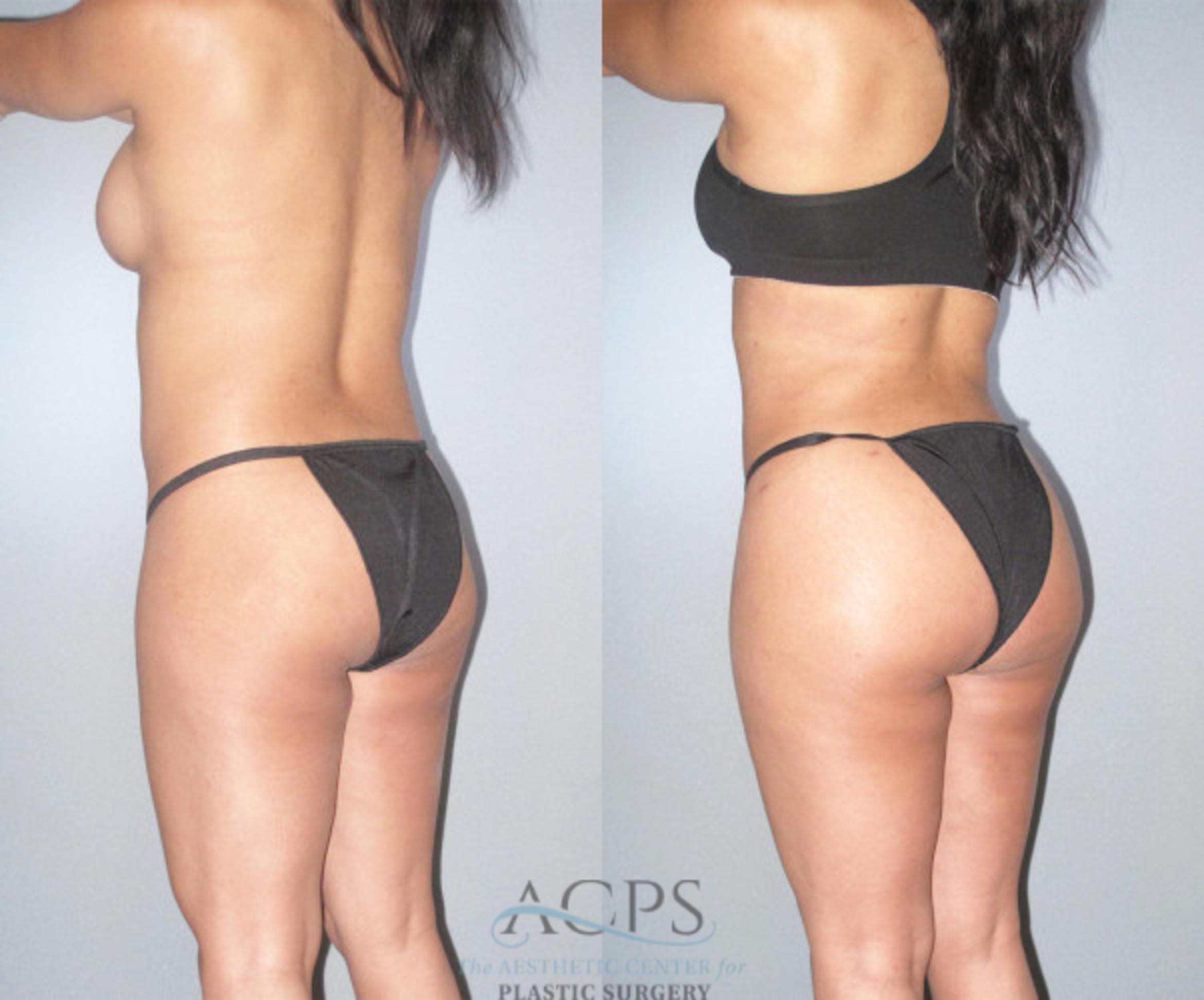 Before & After Brazilian Butt Lift (BBL) Case 479 Oblique Left View: View in Houston, TX
