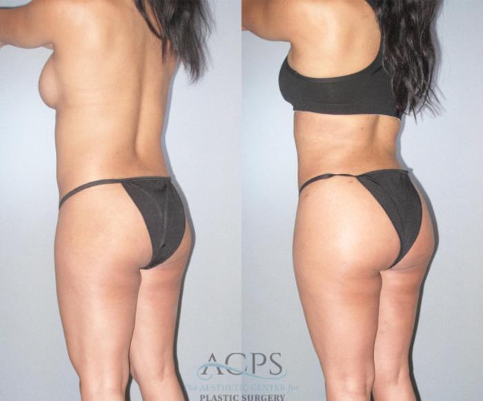 Before & After Brazilian Butt Lift (BBL) Case 479 Oblique Left View: View in Houston, TX