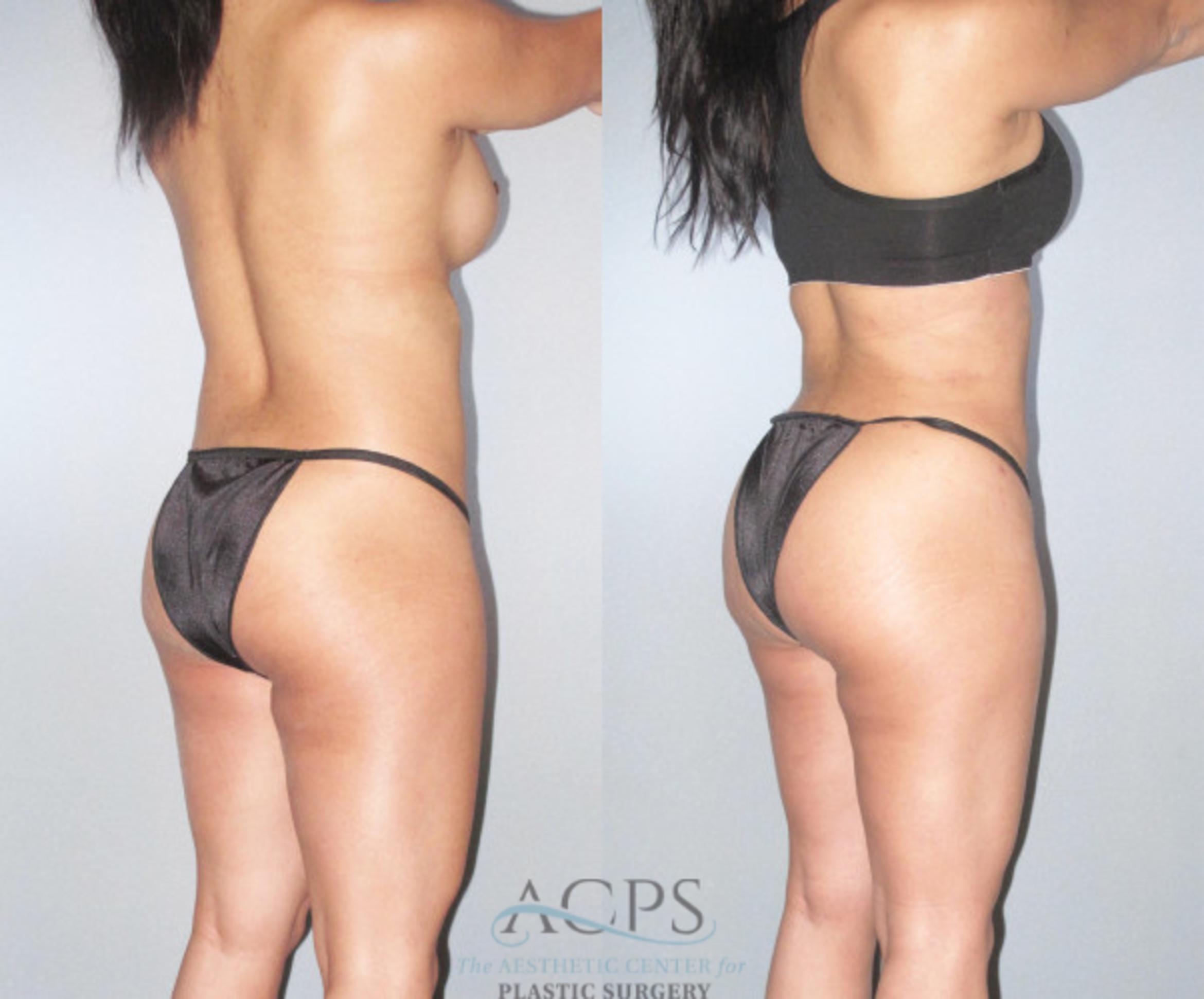 Before & After Brazilian Butt Lift (BBL) Case 479 Oblique View: View in Houston, TX