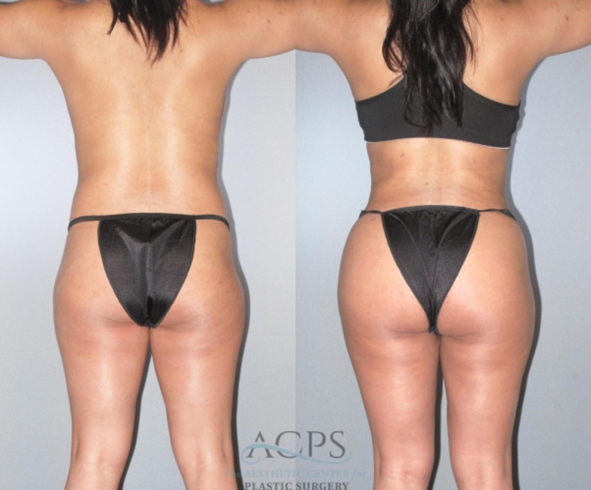 Before & After Brazilian Butt Lift (BBL) Case 479 Rear View: View in Houston, TX