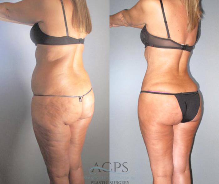 Before & After Brazilian Butt Lift (BBL) Case 480 Oblique View: View in Houston, TX