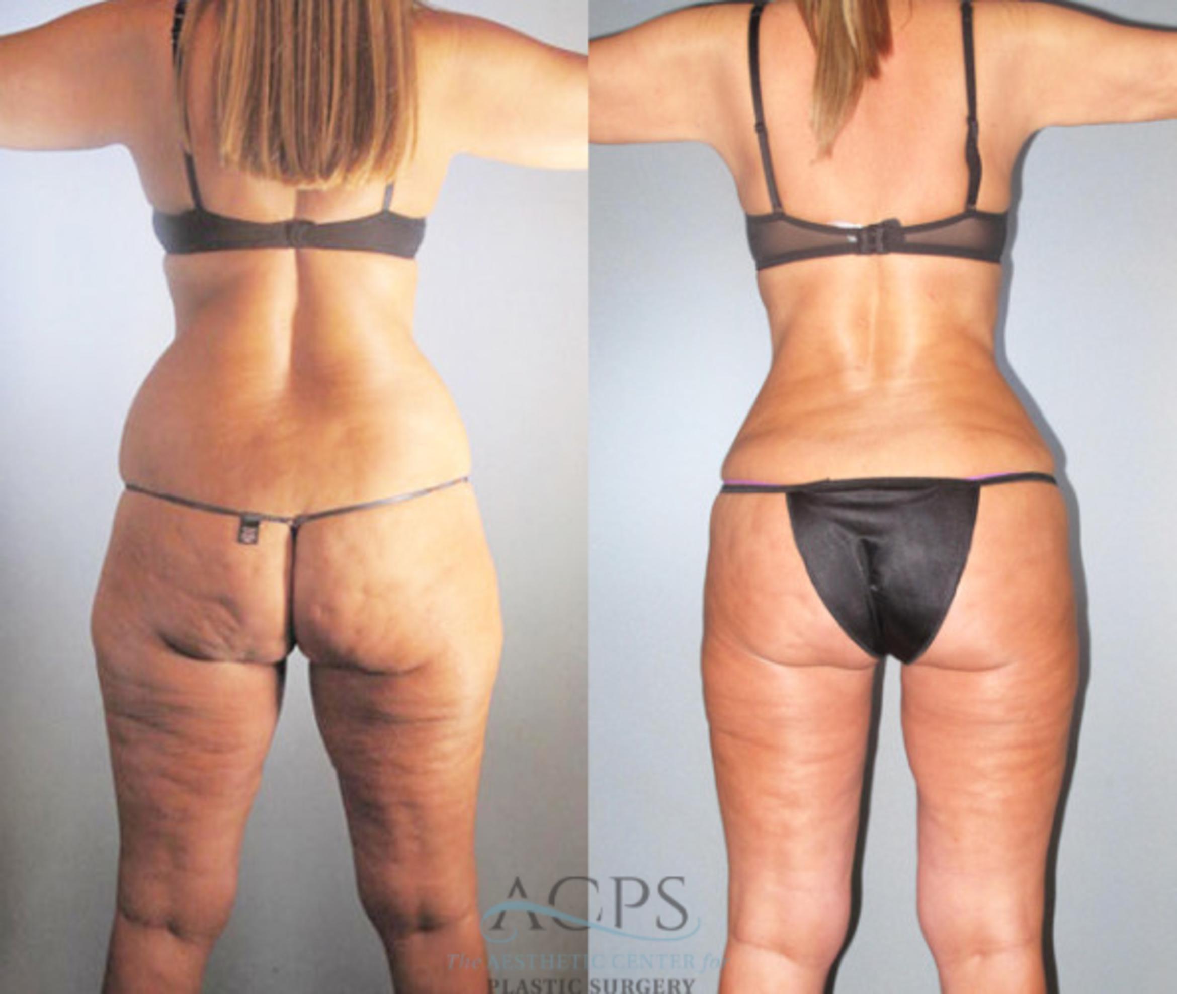 Before & After Brazilian Butt Lift (BBL) Case 480 Rear View: View in Houston, TX