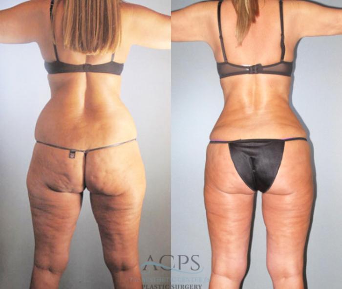 Before & After Brazilian Butt Lift (BBL) Case 480 Rear View: View in Houston, TX