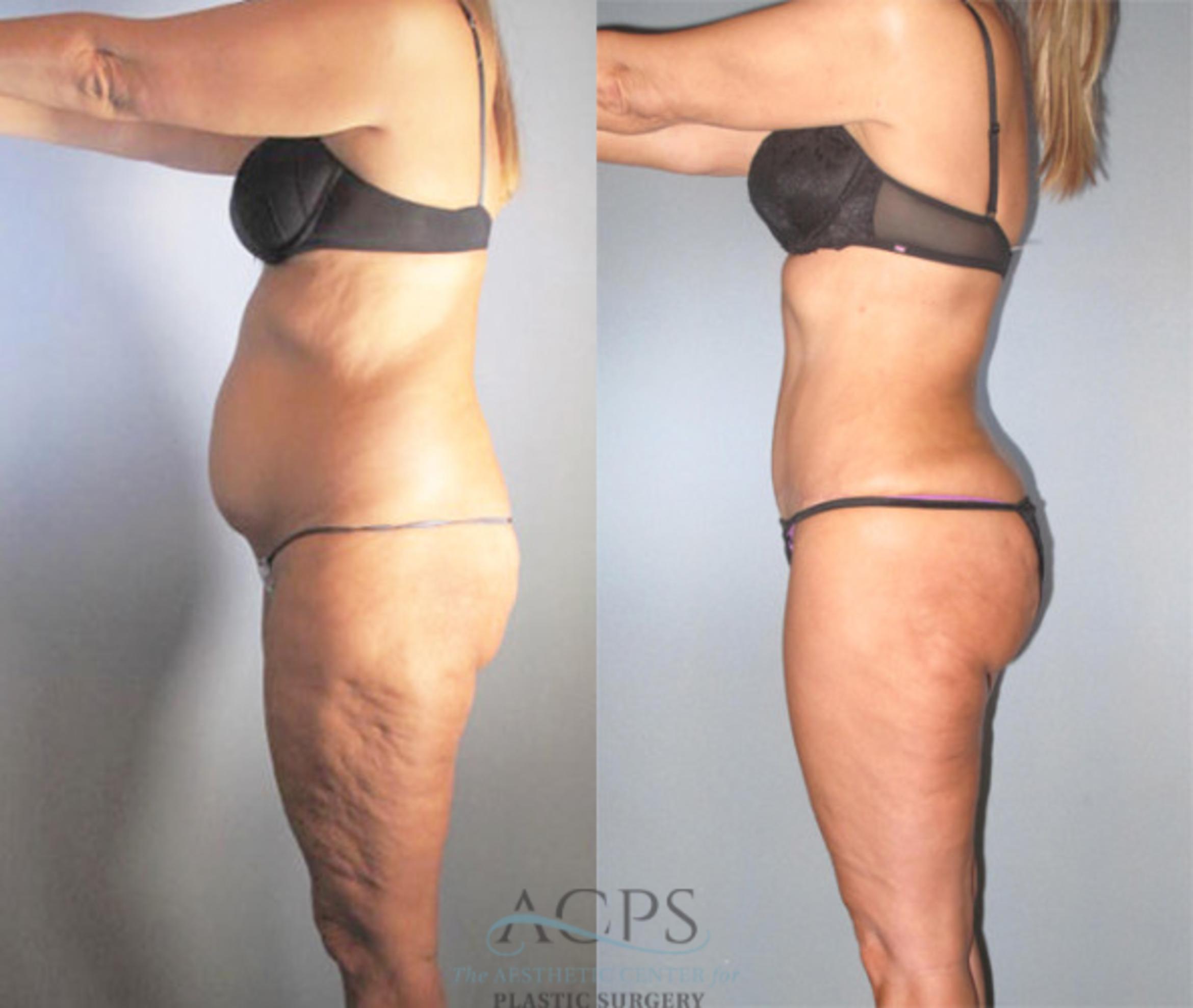 Before & After Brazilian Butt Lift (BBL) Case 480 Side View: View in Houston, TX