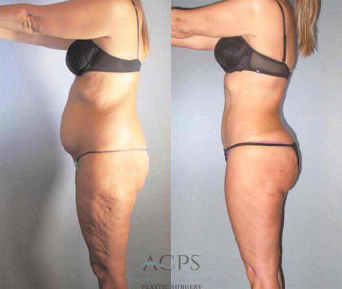 Before & After Brazilian Butt Lift (BBL) Case 480 Side View: View in Houston, TX