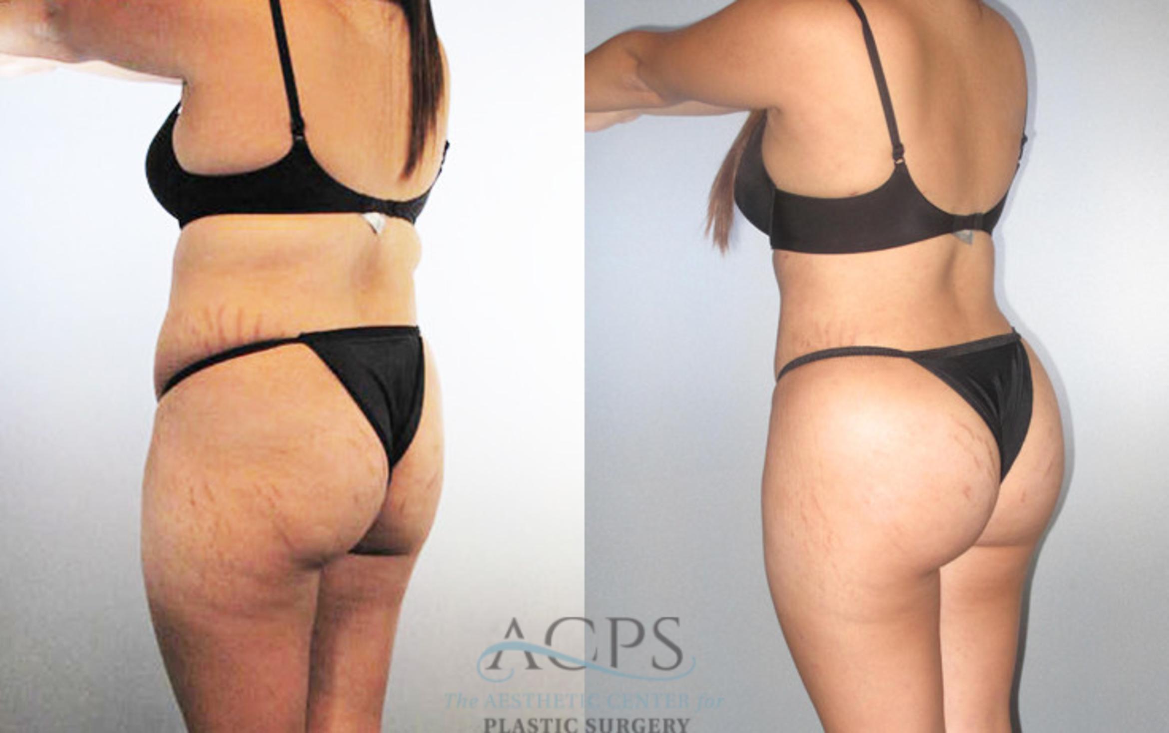 Before & After Brazilian Butt Lift (BBL) Case 481 Oblique View: View in Houston, TX
