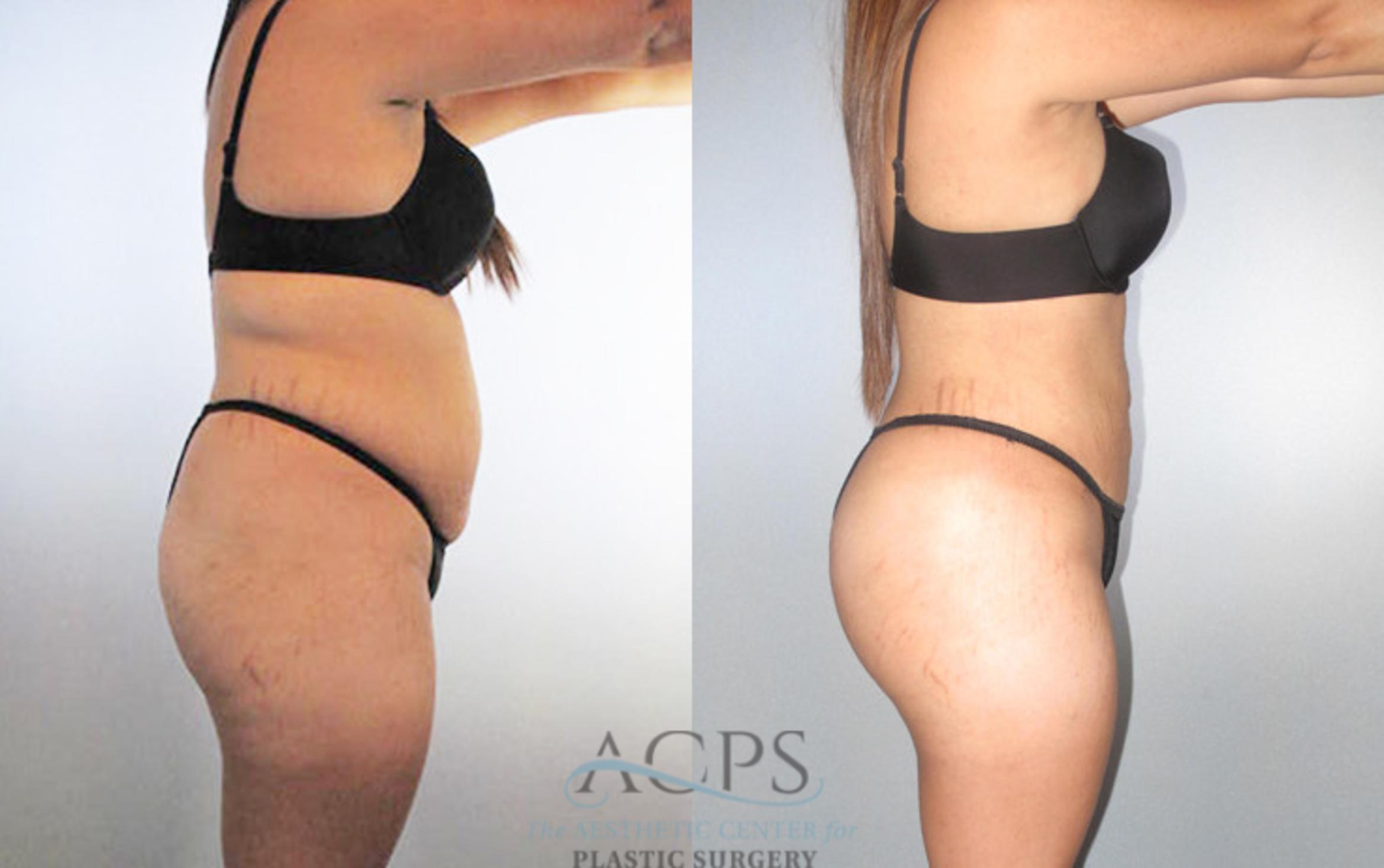 Before & After Brazilian Butt Lift (BBL) Case 481 Side View: View in Houston, TX