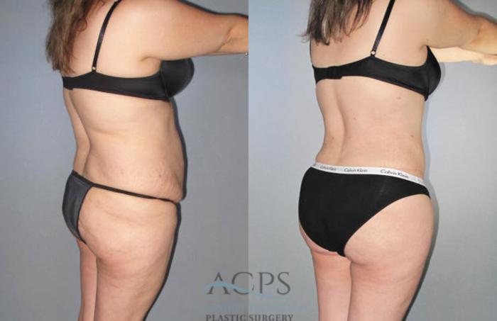 Before & After Brazilian Butt Lift (BBL) Case 482 Oblique View: View in Houston, TX