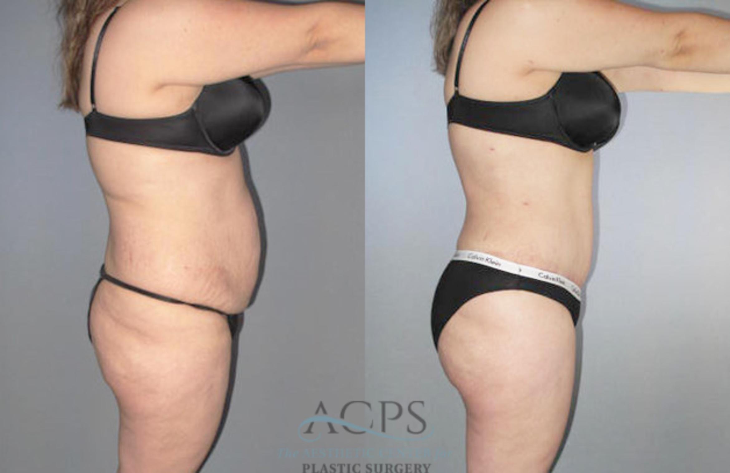 Before & After Brazilian Butt Lift (BBL) Case 482 Side View: View in Houston, TX