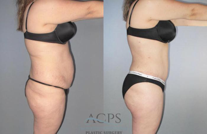 Before & After Brazilian Butt Lift (BBL) Case 482 Side View: View in Houston, TX