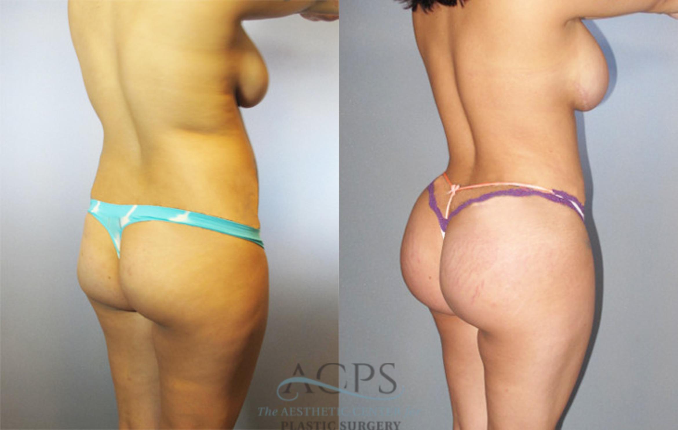 Before & After Brazilian Butt Lift (BBL) Case 483 Oblique View: View in Houston, TX