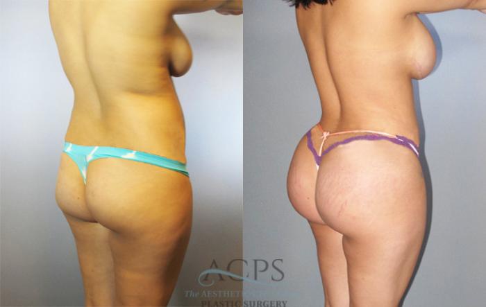 Before & After Brazilian Butt Lift (BBL) Case 483 Oblique View: View in Houston, TX