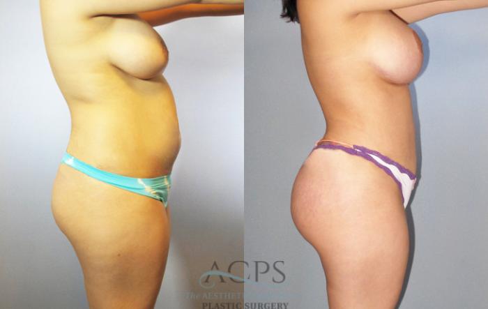 Before & After Brazilian Butt Lift (BBL) Case 483 Side View: View in Houston, TX