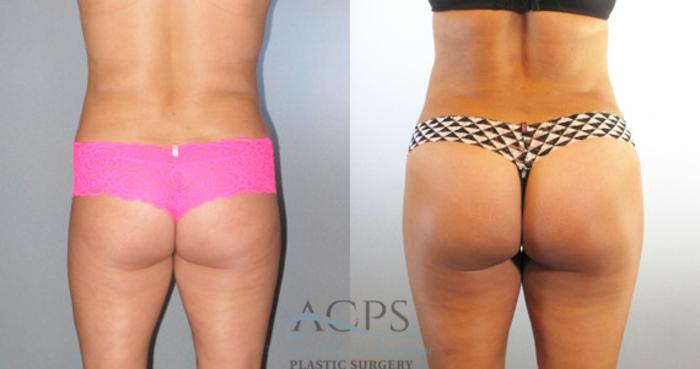 Before & After Brazilian Butt Lift (BBL) Case 484 Rear View: View in Houston, TX