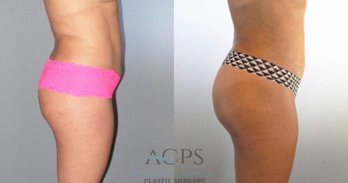 Before & After Brazilian Butt Lift (BBL) Case 484 Side View: View in Houston, TX
