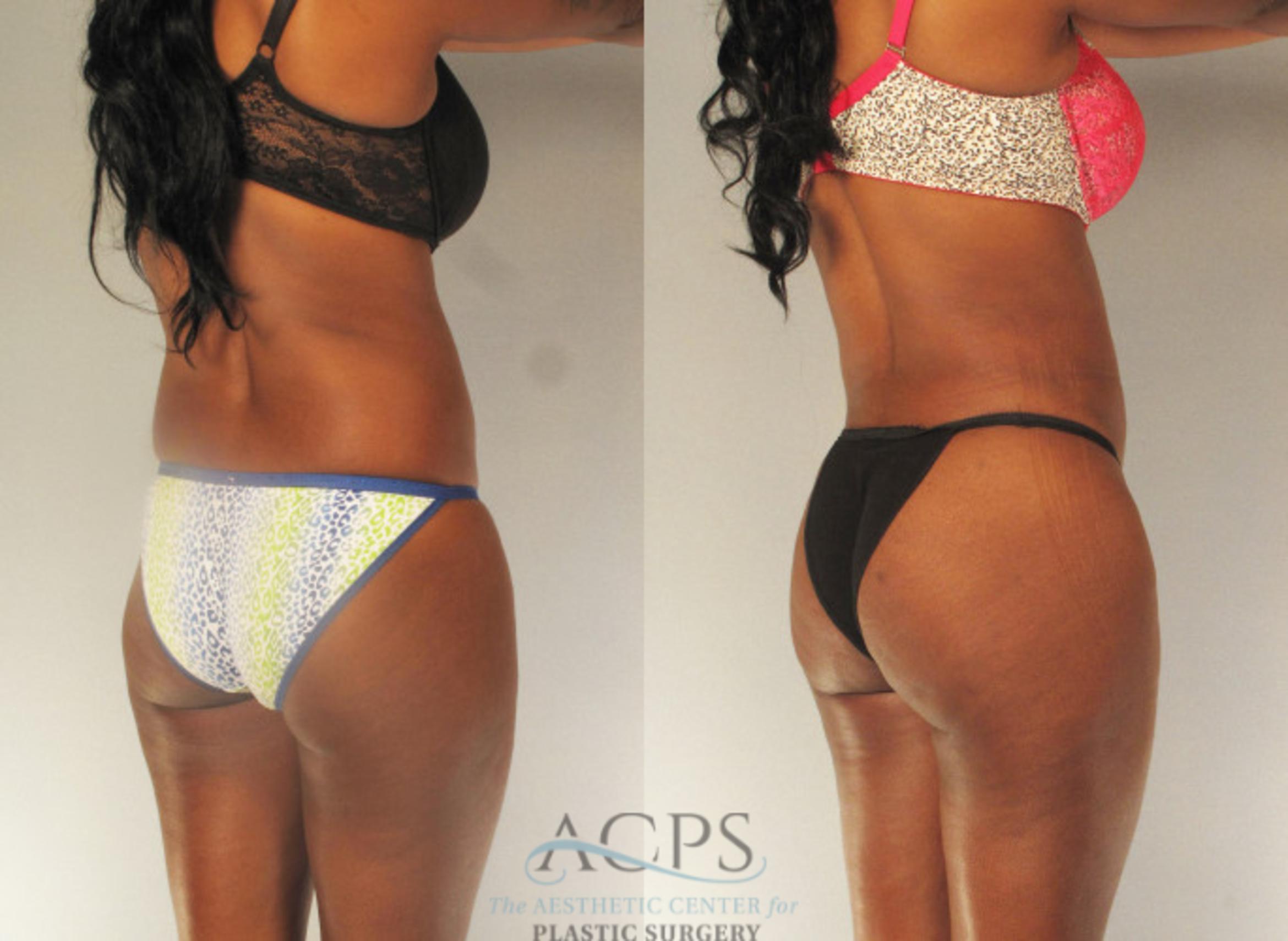 Before & After Brazilian Butt Lift (BBL) Case 485 Oblique View: View in Houston, TX
