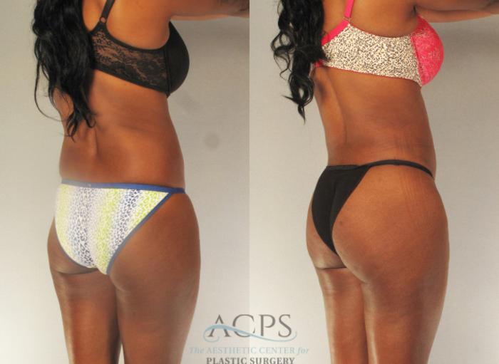 Before & After Brazilian Butt Lift (BBL) Case 485 Oblique View: View in Houston, TX