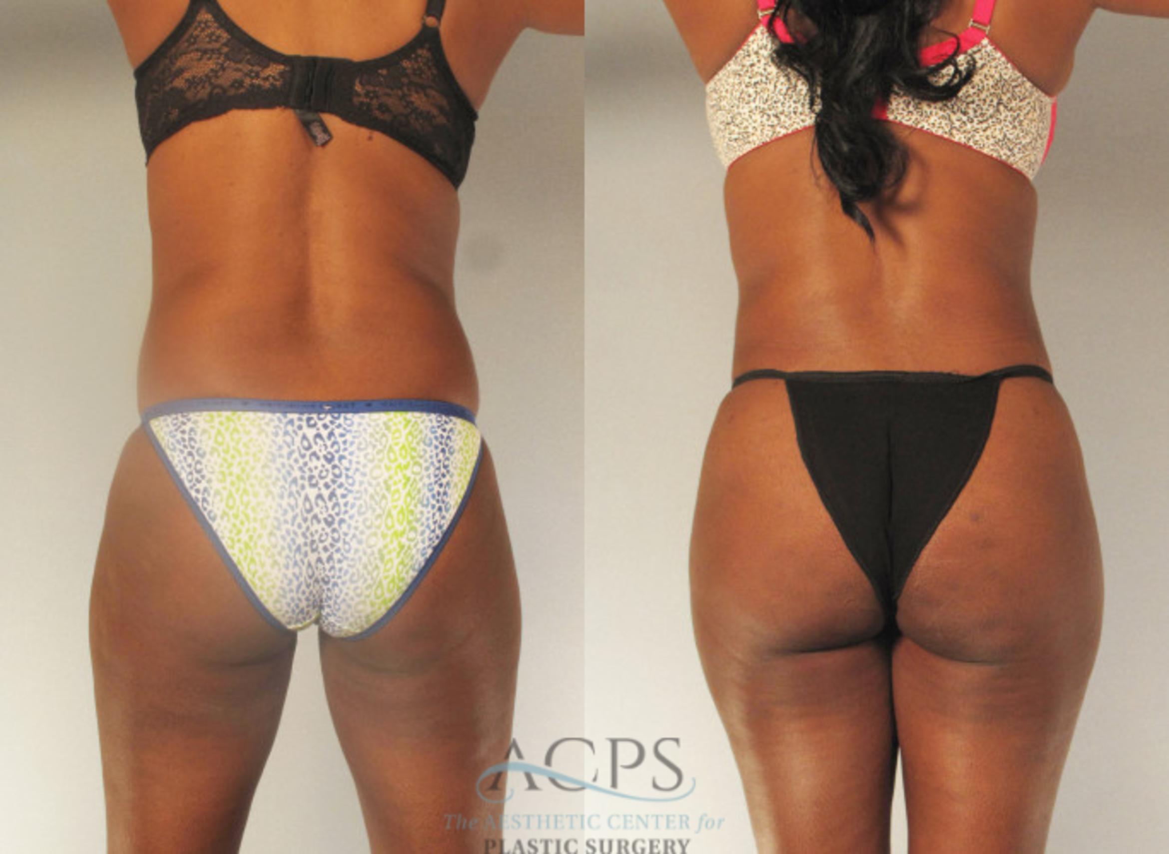 Before & After Brazilian Butt Lift (BBL) Case 485 Rear View: View in Houston, TX