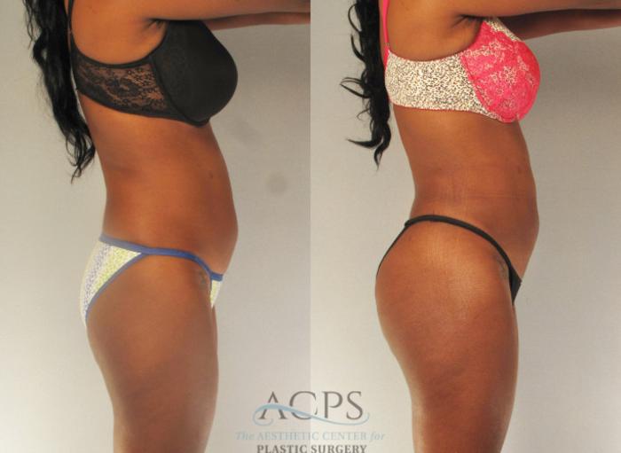Before & After Brazilian Butt Lift (BBL) Case 485 Side View: View in Houston, TX