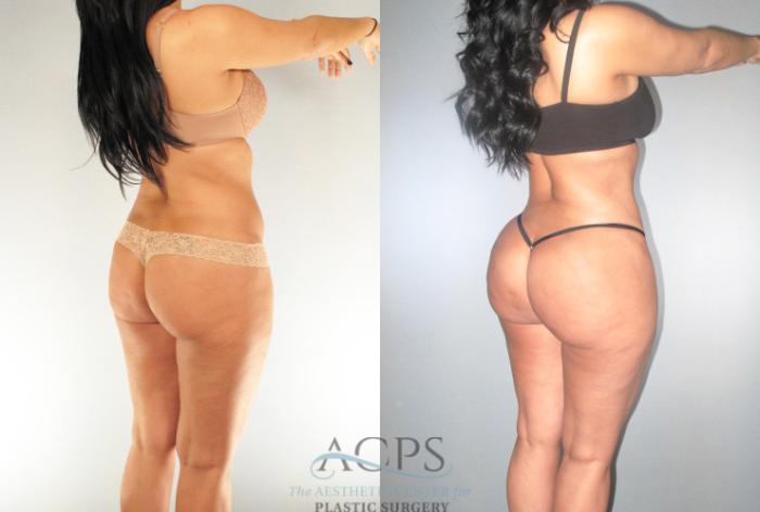 Before & After Brazilian Butt Lift (BBL) Case 486 Oblique View: View in Houston, TX